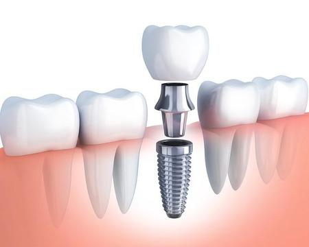 インプラント、人工の歯、連結させるアバットメントという3部品で構成