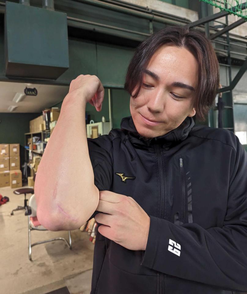 　手術を受けた右肘の傷跡を見つめるケムナ