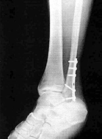 骨折した吉川晃司の左足首のレントゲン写真