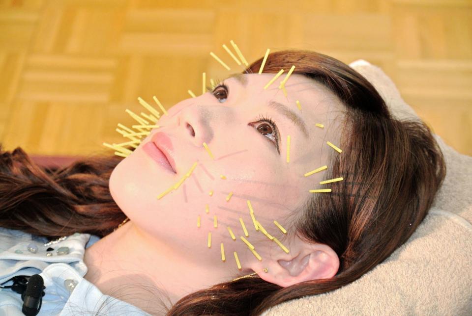 鍼灸を体験し顔が針だらけの田名部生来＝東京・新宿鍼灸柔整歯科衛生専門学校