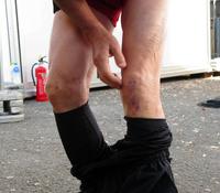 間寛平の両膝のすり傷＝大阪市内