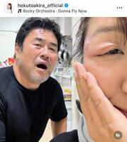 　右目のこめかみに水疱が…。２日付の北斗晶のインスタグラム＠ｈｏｋｕｔｏａｋｉｒａ＿ｏｆｆｉｃｉａｌより 
