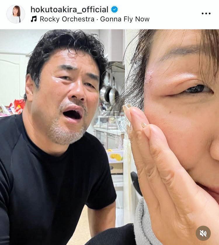 　右目のこめかみに水疱が…。２日付の北斗晶のインスタグラム＠ｈｏｋｕｔｏａｋｉｒａ＿ｏｆｆｉｃｉａｌより 