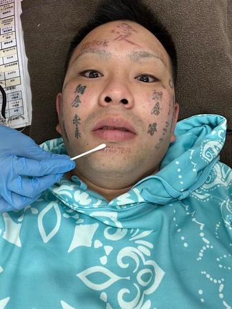 タトゥー除去手術を受けた顔面ニキ