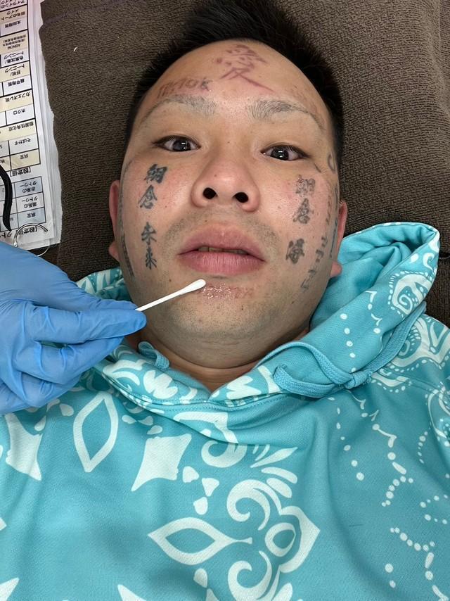 タトゥー除去手術を受けた顔面ニキ