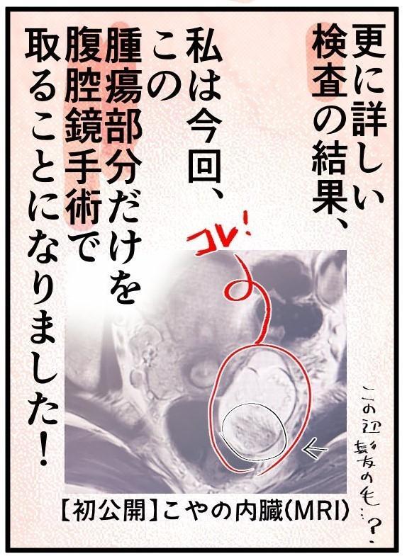 卵巣嚢腫の手術経験を描いた漫画が話題！