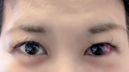 この充血はどちらのパターンでしょうか？