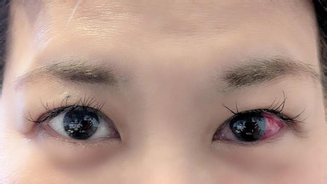 この充血はどちらのパターンでしょうか？