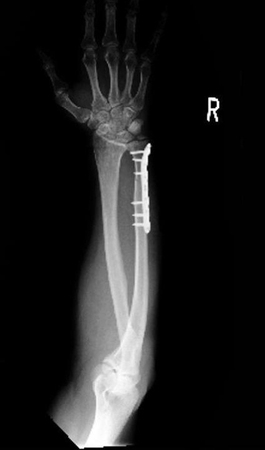 大仁田の手術した右腕のレントゲン写真。プレートを６本のボルトで固定している。