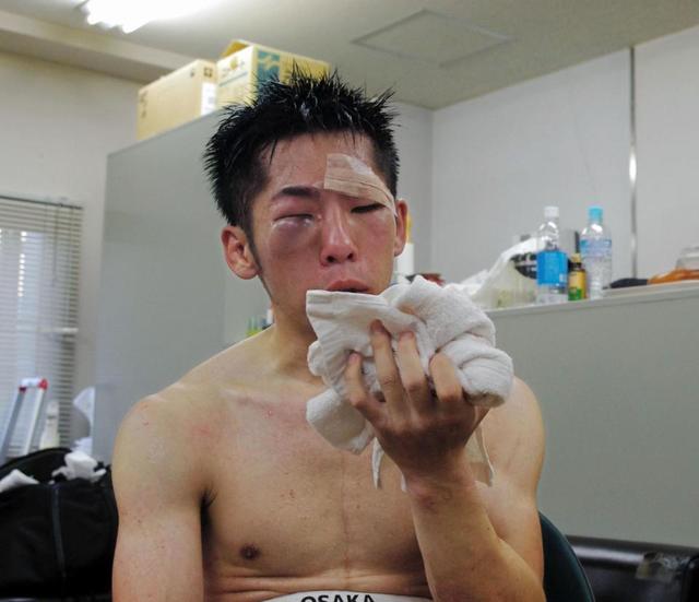 現役大学院生ボクサー・坂本真宏が引退へ　再起戦で敗れ、骨折