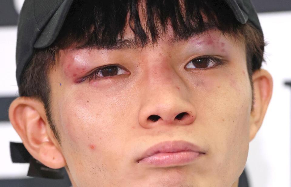 　試合に負け、顔を腫らしながら会見する玖村将史（撮影・吉澤敬太）