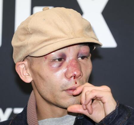 　激闘から一夜明け、痛々しい顔で会見する堤聖也（撮影・金田祐二）