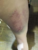 　被害女性が２０日にインスタグラム投稿で示した足の皮下出血（小川泰平氏提供）