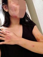 　被害女性が２０日にインスタグラムで公開した顔面や腕、手のあざ（小川泰平氏提供）