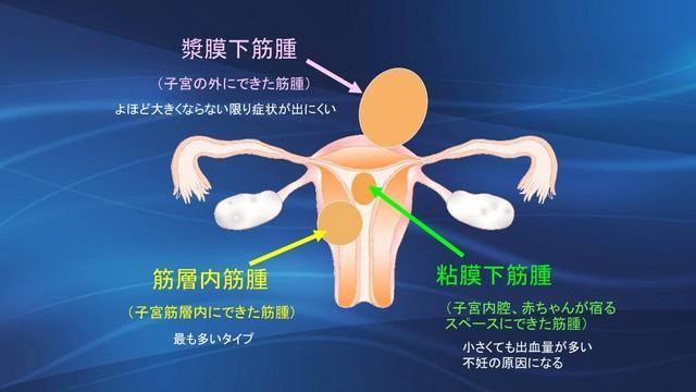 子宮筋腫（川口惠子医師提供）