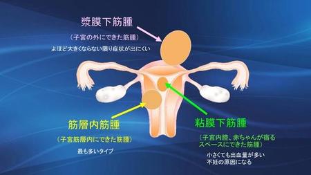 子宮筋腫（川口惠子医師提供）