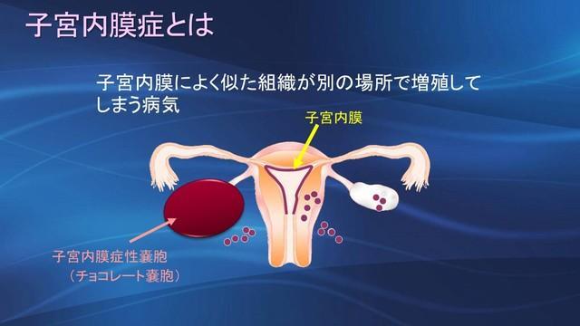 子宮内膜症とは（川口惠子医師提供）