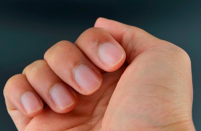 ささくれは、保湿してから絆創膏で保護しよう※画像はイメージです（zulfachri/stock.adobe.com）