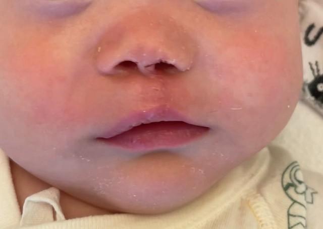 術後8日目でこんなに綺麗に（すいさん提供）