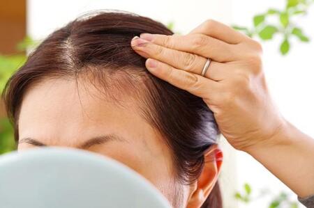 【他人の薄毛】7割が「気になったことがある」　きっかけはエスカレーターや階段