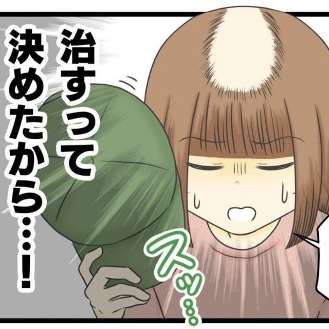抜毛症を治したい！（春乃おはなさん提供）