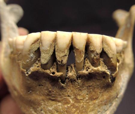 　ウクライナから出土した中世人骨の歯石（オレクサンドラ・コザク博士提供）